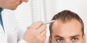FUE method in Turkey Antalya