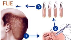 FUE yöntemi ile kimler saç ektirebilir