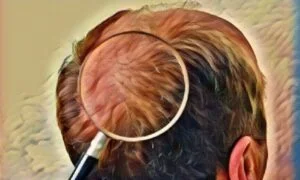 Gegen Haarausfall