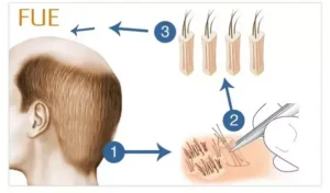 Hair Transplant in Turkey