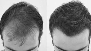 Hair Transplant Prices