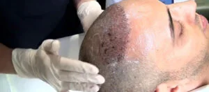 Was ist eine FUE-Haartransplantation